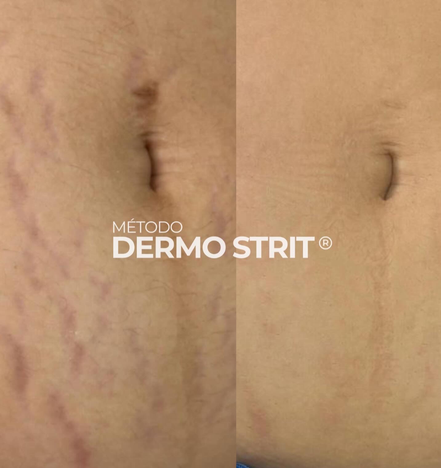 Antes e depois — Método Dermo Strit