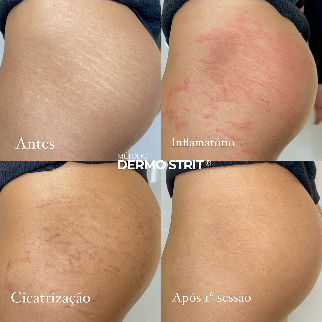 Antes e depois — Método Dermo Strit