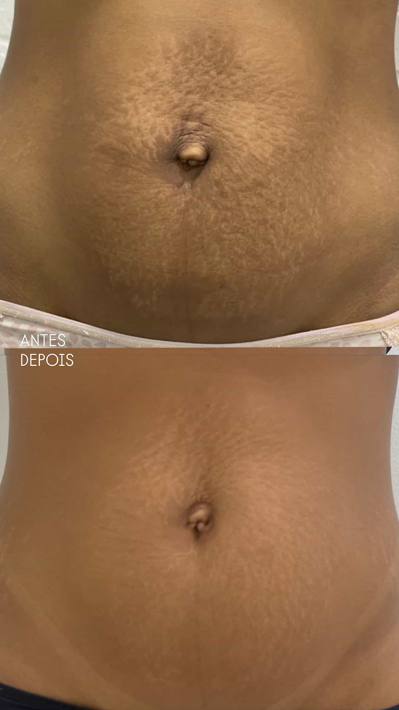 Antes e depois — Método Dermo Strit