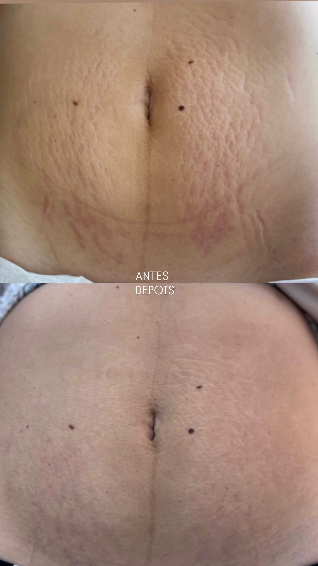 Antes e depois — Método Dermo Strit