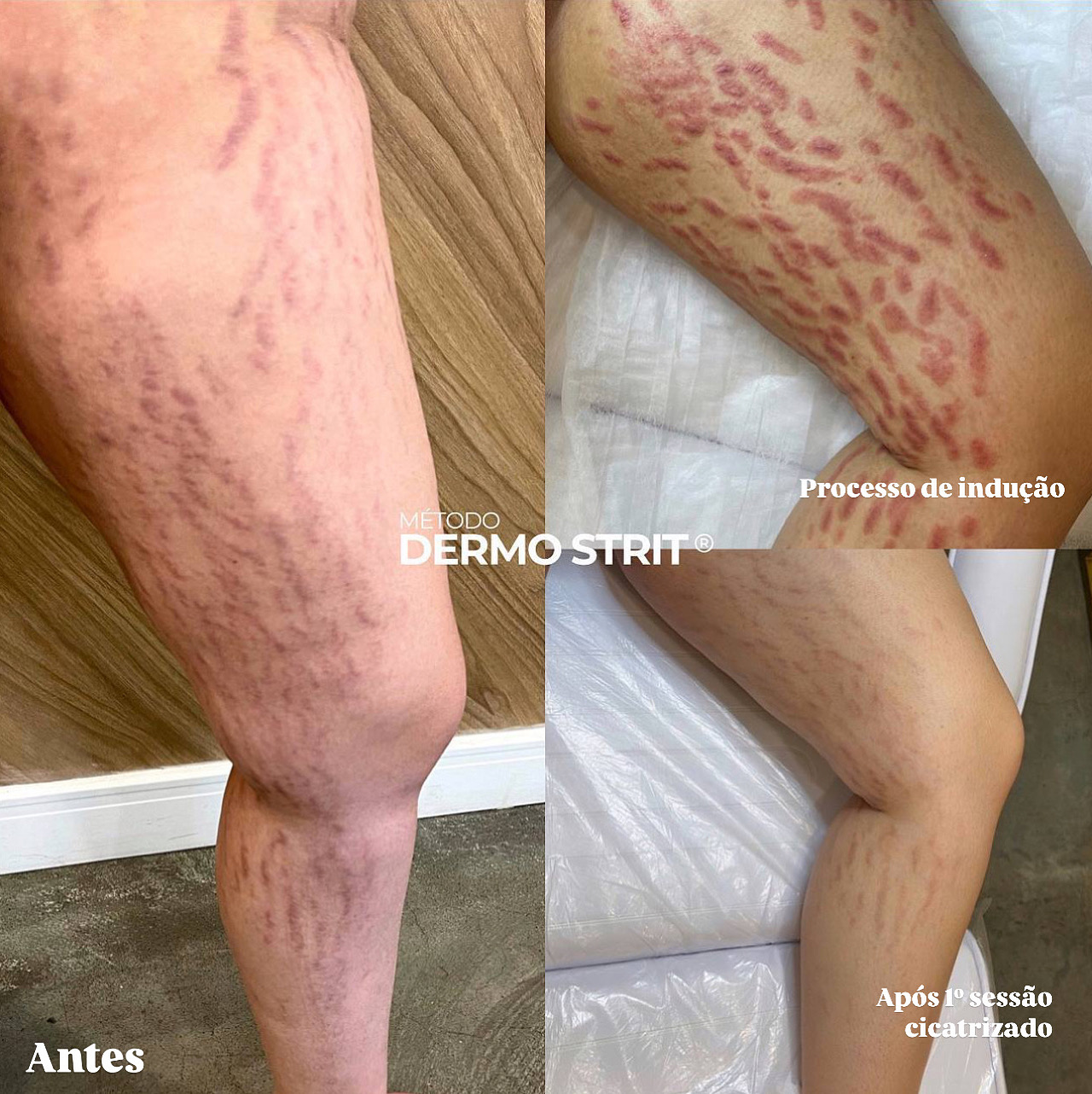 Antes e depois — Método Dermo Strit