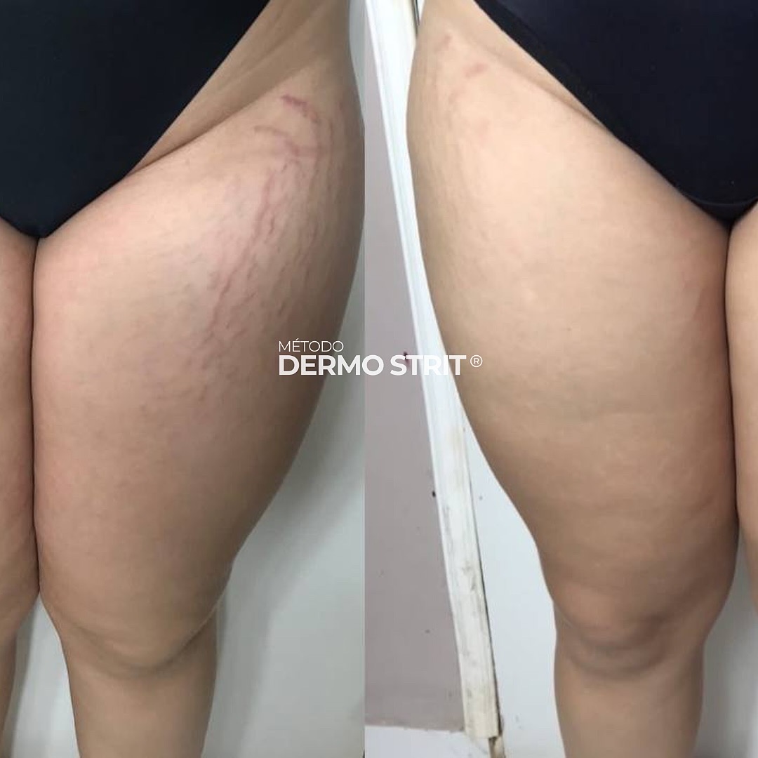Antes e depois — Método Dermo Strit