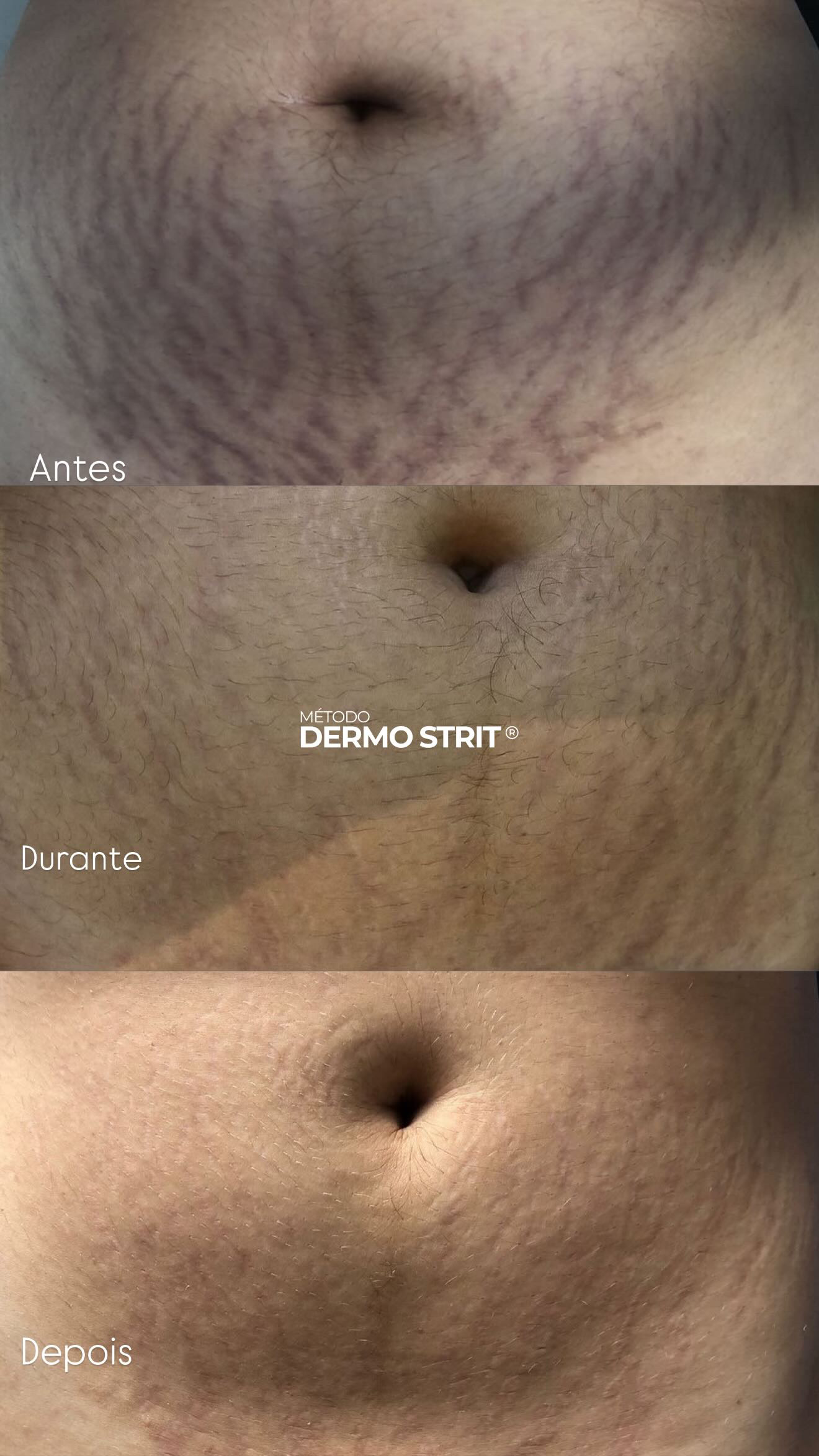 Antes e depois — Método Dermo Strit